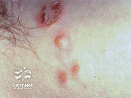 Image result for Impetigo