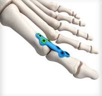 MTP Fusion Plates - Unite Foot and Ankle