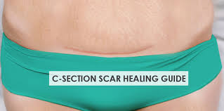 To talk to women about what is healthy and normal after having a baby. C Section Scar Healing Care Guide Stork Mama