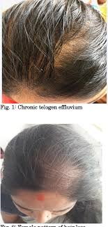 For those of you who know about the tsh, t3 and t4, you will find it fascinating that. A Case Control Study Of Relationship Between Body Iron Stores And Non Scarring Diffuse Hair Loss In Non Menopausal Women Semantic Scholar