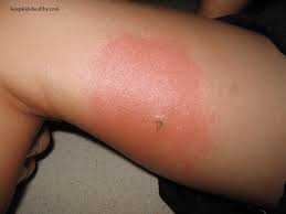 Skeeter syndrome (papular urticaria) is a localized allergic reaction to mosquito bites, consisting of inflammation and sometimes fever. What Is Skeeter Syndrome Keep Kids Healthy