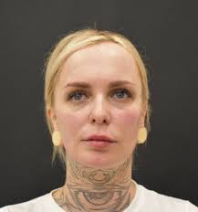 8 Point Liquid Facelift