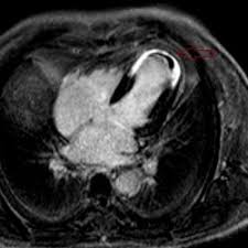 Ein in der mrt nachweisbares lge ist dabei nachweislich mit einer ungünstigeren prognose und einer erhöhten rate kardialer ereignisse assoziiert. Kardio Mrt