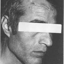 Results of metapyrone test