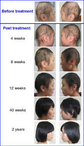 Follow my breast cancer journey here: Regrowth Of Hair Following Stem Cell Educator Therapy A Subject With Download Scientific Diagram