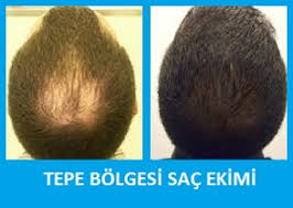 Tepe Bolgesi Sac Ekimi Vertex Bolgesi Sac Ekimi Destek
