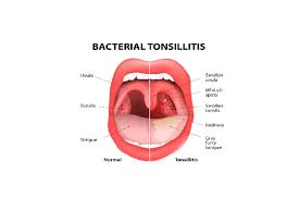 What Your Tongue And Tonsils Are Saying About You