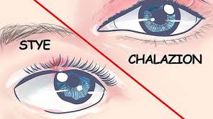 How To Get Rid Of Chalazions How To Get Rid Of Things Eye Stye Remedies Stye Remedy Stye Treatment