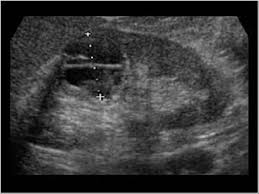 Multilocular Cyst Longitudinal Diagnostic Medical Sonography Ultrasound Sonography Ultrasound