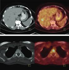 Clinical tests, including cat scans, had determined that all of these. The Value Of 18f Fdg Pet Ct Imaging In Breast Cancer Staging Bosnian Journal Of Basic Medical Sciences