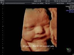 33 Week Baby Girl In Hd Live The 4d Ultrasound Lady Facebook
