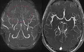 Moyamoya Disease Wikipedia