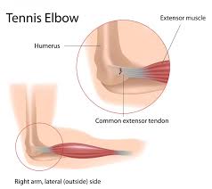 The bicep is located in the front of the upper arm, and it has two heads: Elbow Injury Torn Tendons Tendonitis Repair