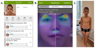Clinical Case of Mild Tatton&ndash;Brown&ndash;Rahman Syndrome Caused by a  Nonsense Variant in DNMT3A Gene