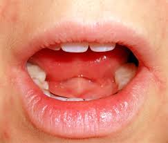 Image result for Angular Stomatitis