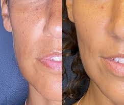 After you begin supplementing with vitamin d, it may take up to a week for your blood levels to rise how much water will it take to rehydrate your body? Sculptra The Perfect Filler For Loss Of Volume Van Lennep