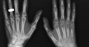 Pin On Musculoskeletal Radiology