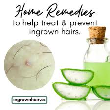24 Home Remedies To Treat And Prevent Ingrown Hairs