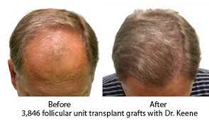 Hair transplants are not permanent, and your hair may still thin over the years. Fine Hair And Large Bald Area Hair Transplant Web