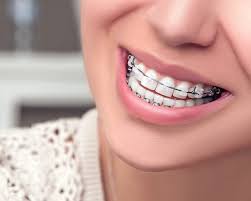 Small bits are stuck onto protruding wires. What To Know About Brace Removal And After Braces Dental Care Dentist In San Rafael Ca