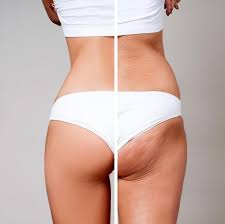 Maybe you would like to learn more about one of these? Schone Beine So Werden Sie Cellulite Endlich Los Gala De