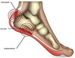 Suggest remedies for the bone spur and make. Heel Pain Treatment Doctors Top Rated Pain Specialists Brooklyn Nyc