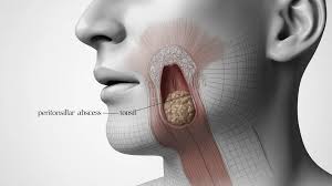 Image result for Peritonsillar Abscess