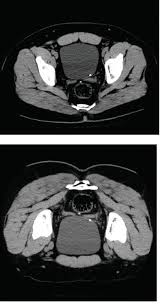 Image result for Helical CT Urogram