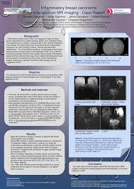 In around 30% of inflammatory breast cancers cases there is no lump (or tumor). Pdf Inflammatory Breast Carcinoma Only Seen On Mr Imaging Case Report