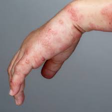 Image result for shingles in children
