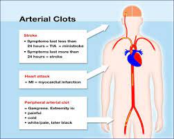 What Is A Blood Clot Unc Hemophilia And Thrombosis Center