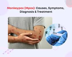 Image result for Monkeypox