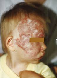 Cutaneous manifestations in Moyamoya angiopathy: A review