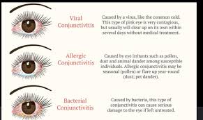 Image result for Allergic Conjunctivitis