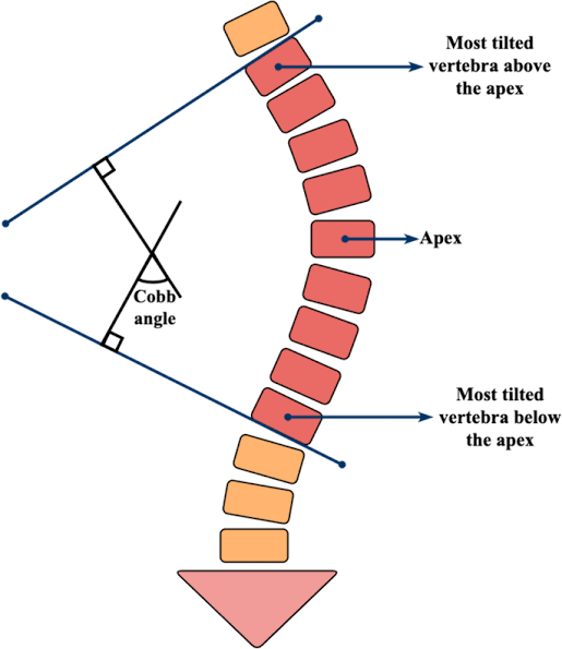 ما زاوية كوب (Cobb Angle)؟