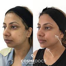 Super angebote für long lasting hier im preisvergleich. Jaw Filler Before And After Experience True Jaw Dropping Results