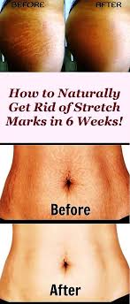 Bio Oil White Stretch Marks Before And After Stretch Marks Are Lesions That Appear On The Skin Especially In The Abdomen Hips And Breasts Stretch Marks Bio Oil Stretch Marks Effective Skin Care Routine