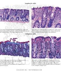 Image result for Microscopic Colitis
