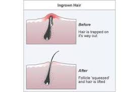 How To Naturally Get Rid Of Ingrown Hairs Ehow Ingrown Hair Remedies Infected Ingrown Hair Ingrown Leg Hair