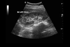 Renal Venous Infarct On Ultrasound Ultrasound Renal Sonography