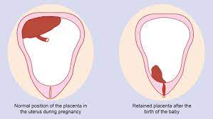 Retained Placenta Pregnancy Birth And Baby