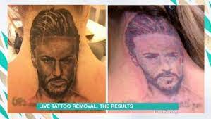 Tattoo removal training with candice watson. How Does Tattoo Removal Work How Much Does It Cost And What Will It Look Like Before And After