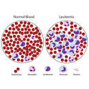 Leukemia - Vejthani Hospital | JCI Accredited International ...