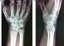 Image result for Scapholunate Dislocation