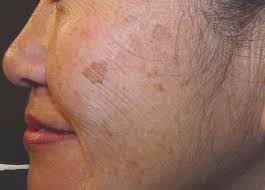 Penggunaan masker cukup efektif dalam mengatasi jerawat dan flek hitam diwajah. 3 Cara Hilangkan Jeragat Degil Diet Diet Sihat