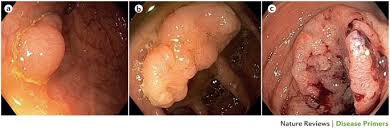 Most of these symptoms are more likely to be caused by things other than stomach cancer, such as a viral infection or an ulcer. Colorectal Cancer Nature Reviews Disease Primers