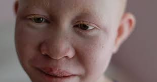 New limbs, new hope for Africa's hunted albino children