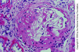 We did not find results for: Nefropatia Por Inmunoglobulina A Trastornos Urogenitales Manual Msd Version Para Profesionales