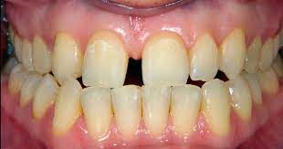 Why Are My Teeth Yellow 12 Reasons Your Pearly Whites Are Off Colour Yellow Teeth Teeth Off Colour