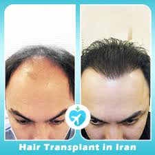 Maybe you would like to learn more about one of these? Fut Vs Fue Comparison What You Need To Know